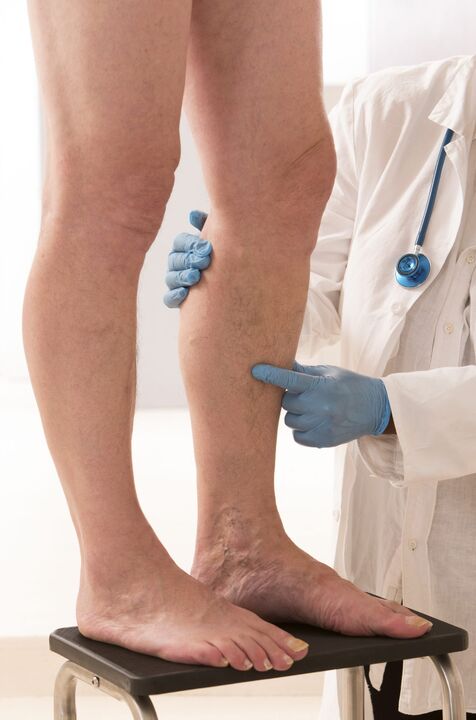 Varicosis wat is het