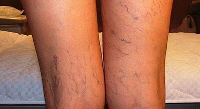 Hoe de uitbreiding van de varicone bij vrouwen bij vrouwen te behandelen