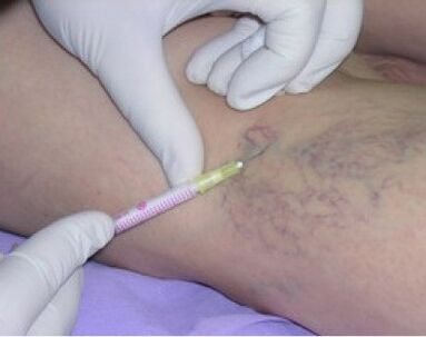 injecties voor spataderen