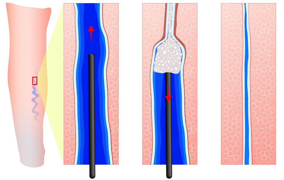 Mechanisme van sclerotherapie